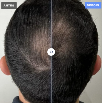 Paciente A., 4 meses de tratamento